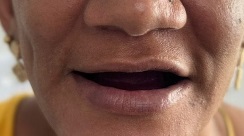 Sorriso da paciente sem os dentes superiores, no início do tratamento