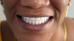 Sorriso da paciente com a prótese, ao final do tratamento