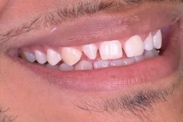 Sorriso do paciente com dentes desalinhados e de cores diferentes, no início do tratamento