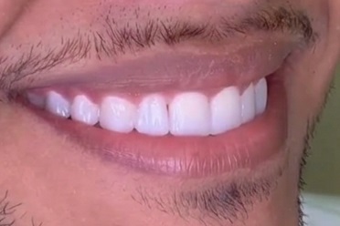 Sorriso do paciente com dentes alinhados e uniformes, ao final do tratamento